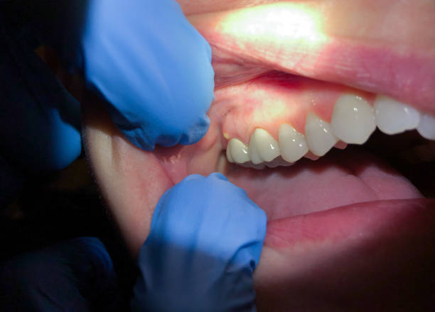 Best Emergency Treatment for Dental Infections or Abscesses in Deephaven, MN